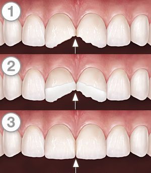 Tooth colored Fillings/bonding – Smiles of Arlington Heights